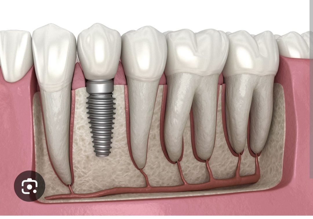 Dental Implants in Sector 92 & 93 Gurgaon | Alps Dental Care